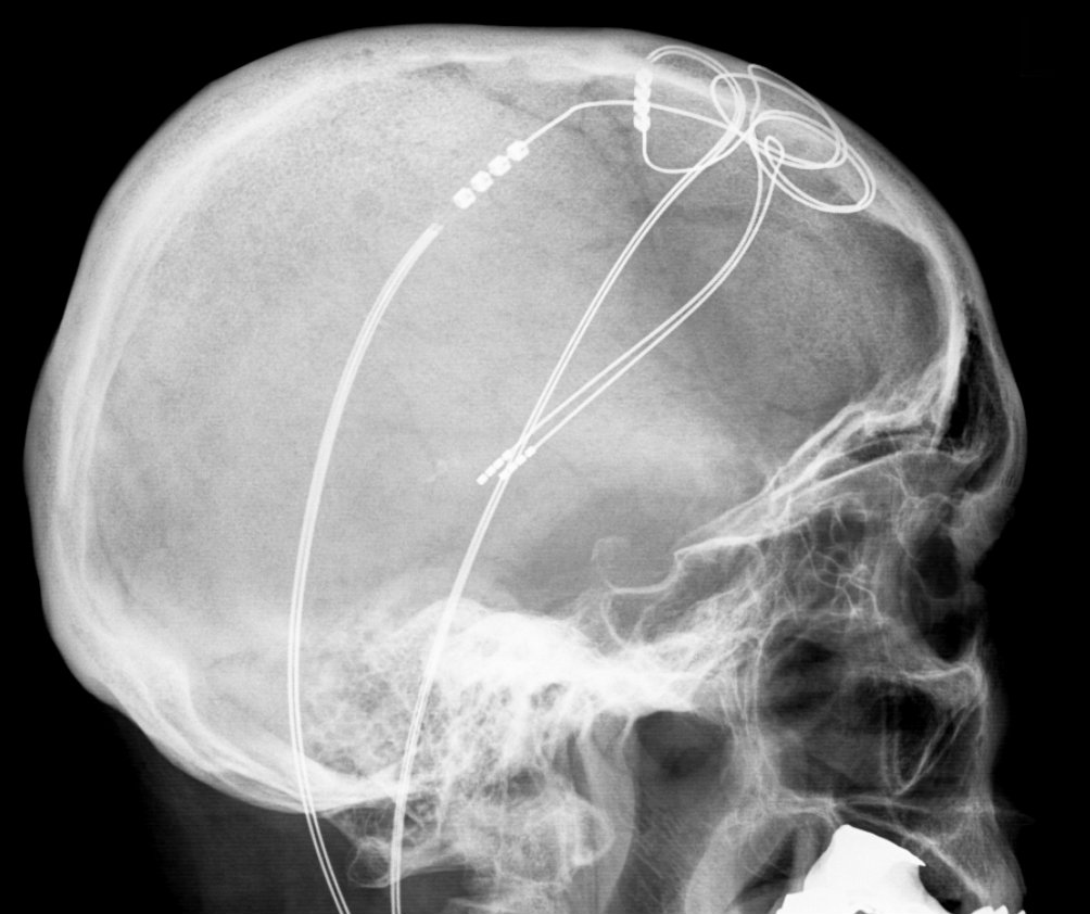 Lateral skull X-ray with two DBS leads