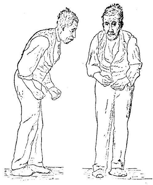 Gowers' 1886 sketch of Parkinson's disease