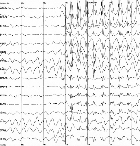 EEG 3 Hz spike-and-wave discharge